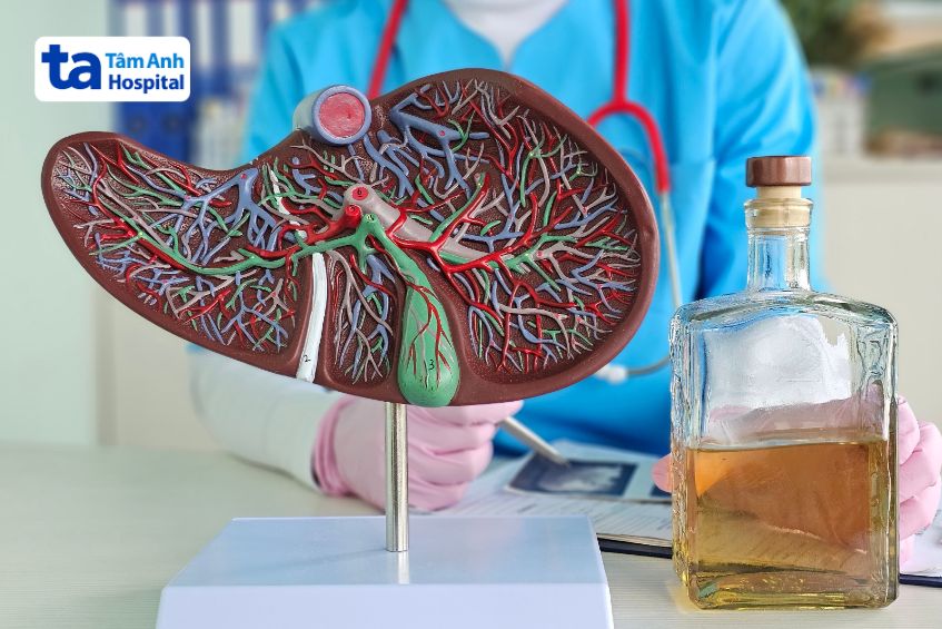 Triệu chứng gan nhiễm mỡ do bia