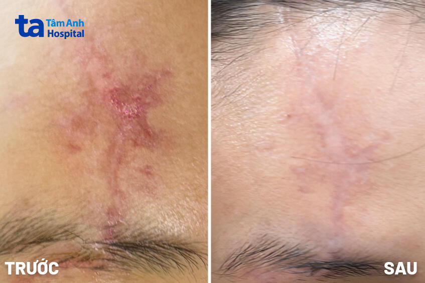 trước và sau điều trị laser
