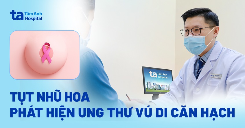 Tụt nhũ hoa phát hiện ung thư vú di căn hạch