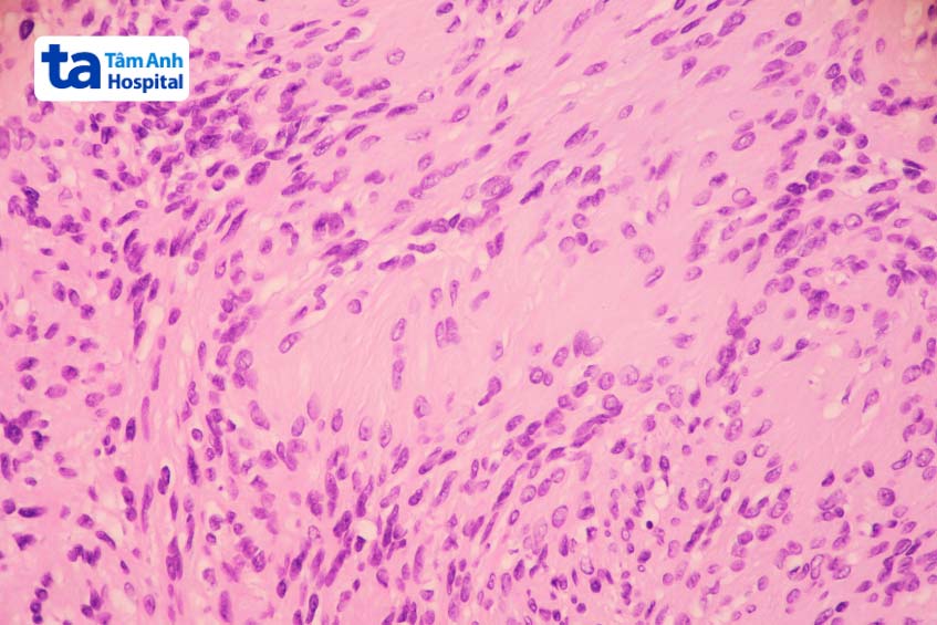 u dây thần kinh số 8 là khối u lành tính