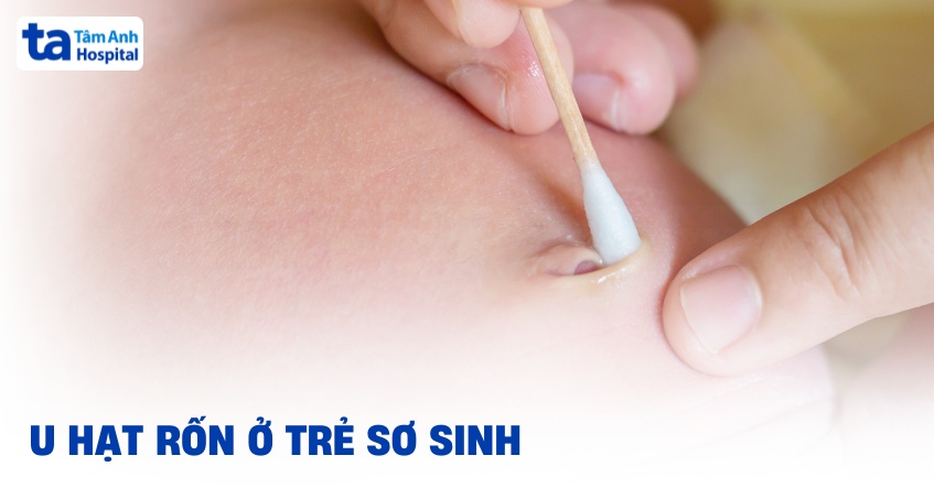U hạt rốn ở trẻ sơ sinh: Nguyên nhân, triệu chứng và chẩn đoán