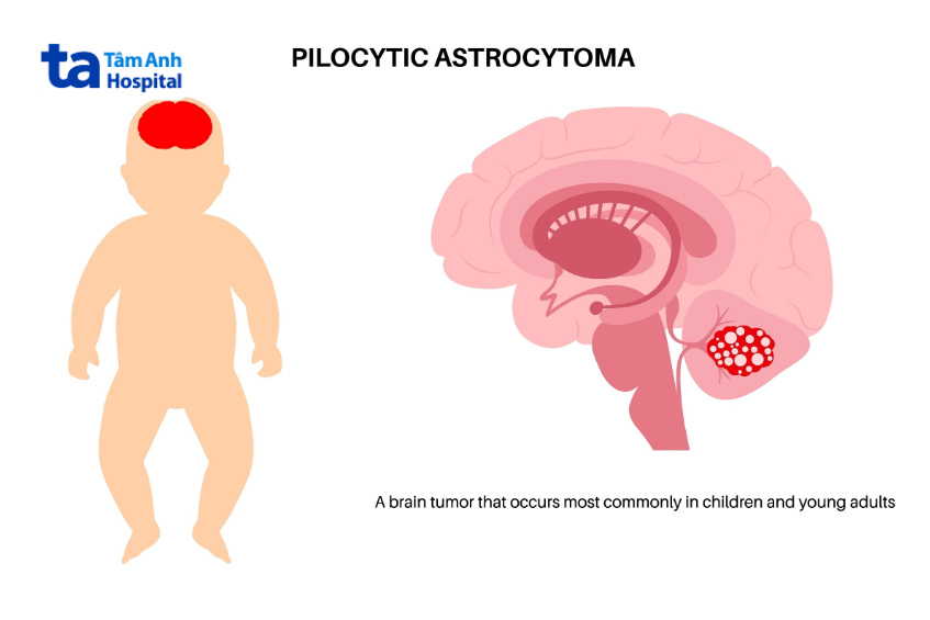 u tế bào hình sao