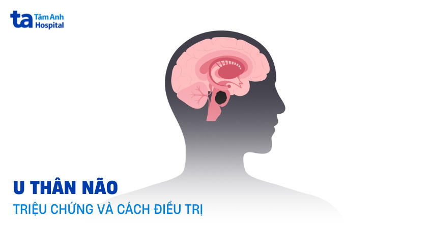 U thân não có chữa được không? Triệu chứng và cách điều trị