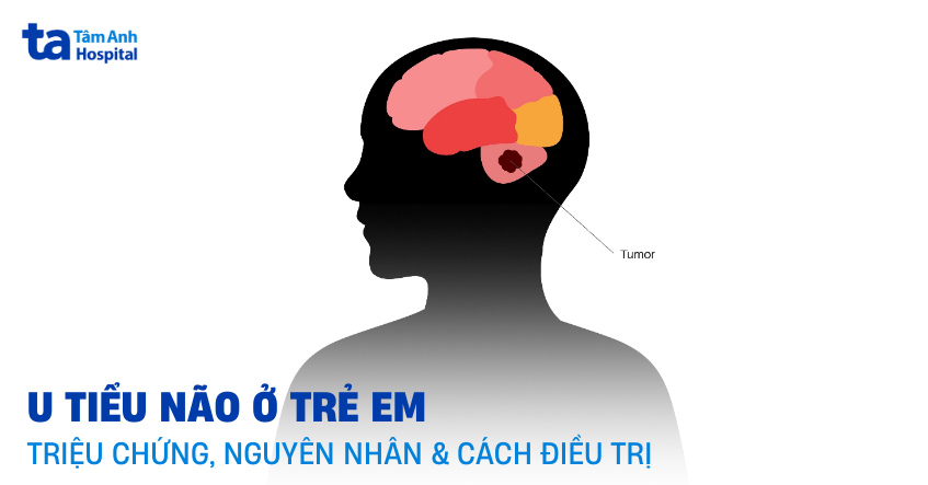 U tiểu não ở trẻ em: Triệu chứng, nguyên nhân và cách điều trị