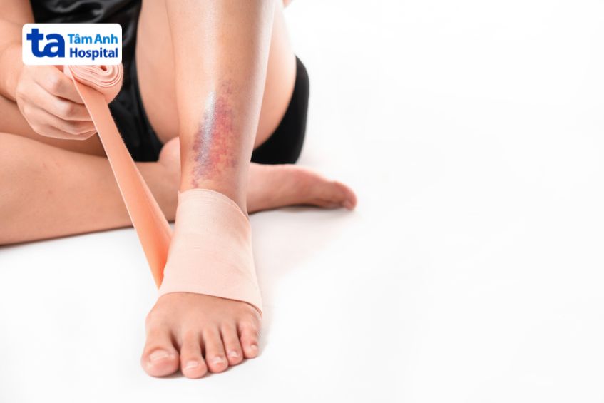 Vết bầm sau khi bị chấn thương chân