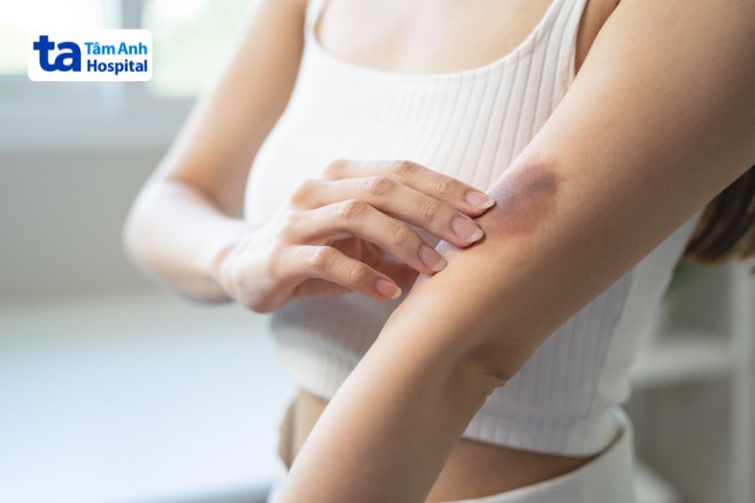 Vết bầm tím là gì?