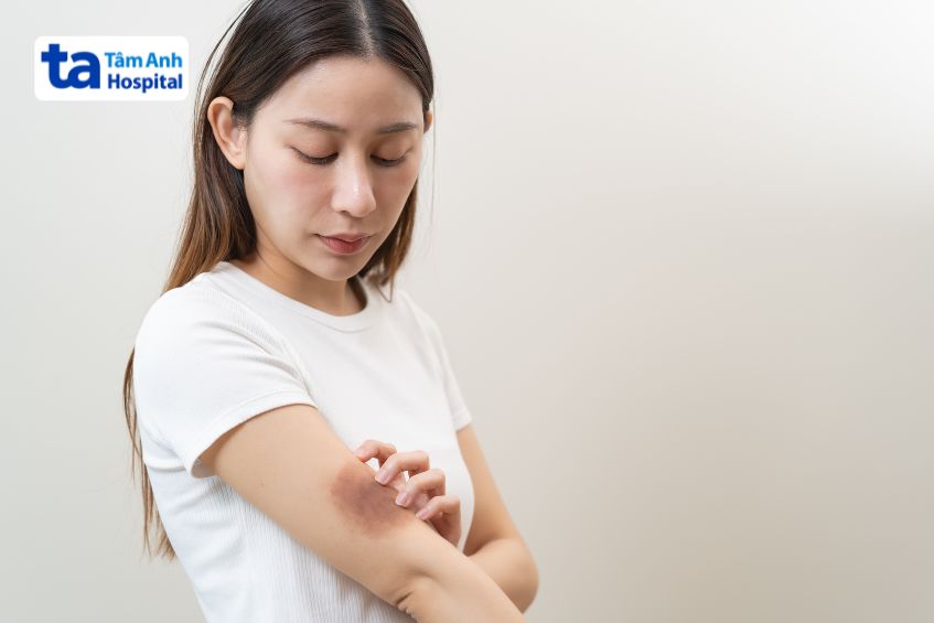 Vết bầm xuất hiện ở cánh tay do va đập