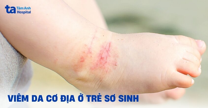 Hướng dẫn xử lý viêm da cơ địa ở trẻ sơ sinh cho cha mẹ