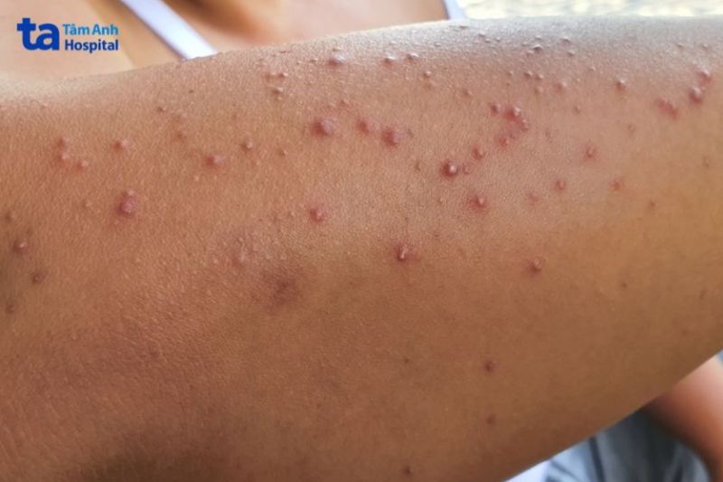 hình ảnh viêm nang lông ở tay