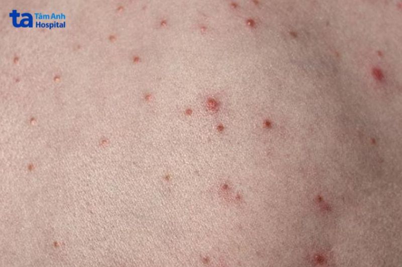 dùng liệu pháp ánh sáng chữa viêm nang lông