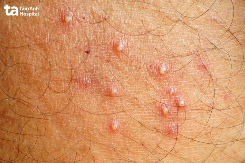 mụn viêm đỏ là dấu hiệu nhann biết viêm lỗ chân lông