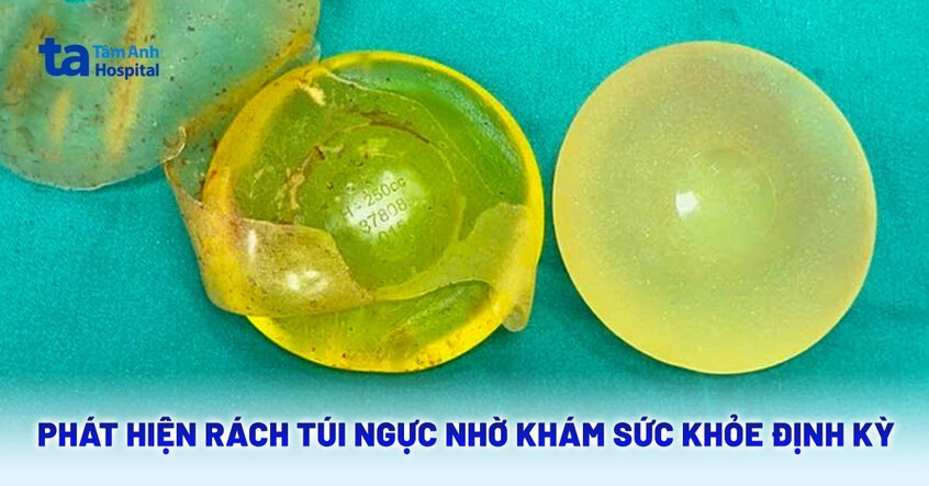 Vỡ túi ngực silicon sau 22 năm