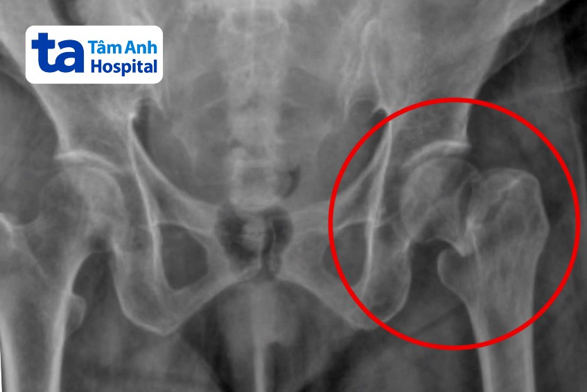 x quang bà hòa bị gãy cổ xương đùi