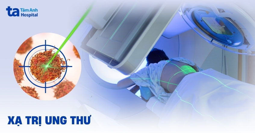 Xạ trị ung thư quy trình khi nào cần? Mục đích có tác dụng gì?