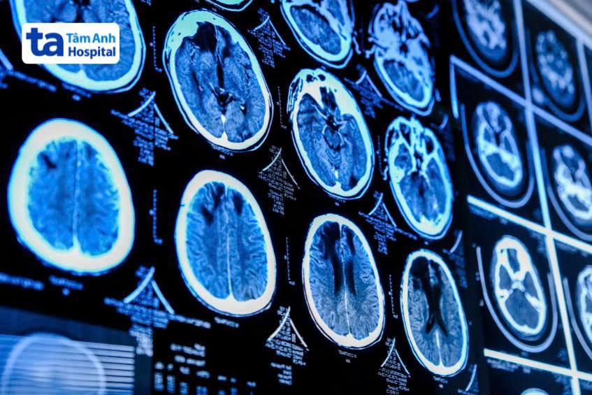 xét nghiệm hình ảnh chẩn đoán u dây thần kinh số 8