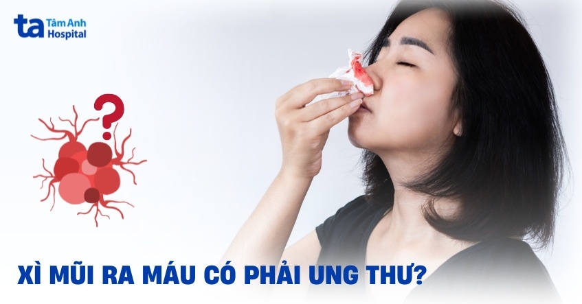 Xì mũi ra máu có phải ung thư không? Khi nào cần lưu ý?