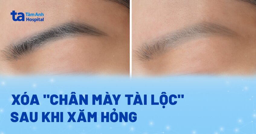 xóa chân mày tài lộc vì xăm hỏng