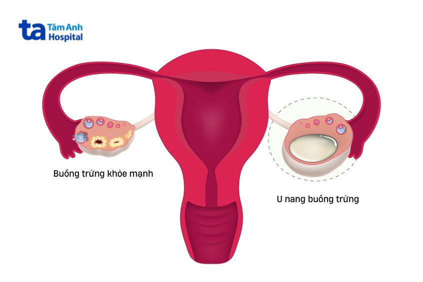 U nang buồng trứng có thể xuất hiện trên một hoặc cả hai buồng trứng của phụ nữ