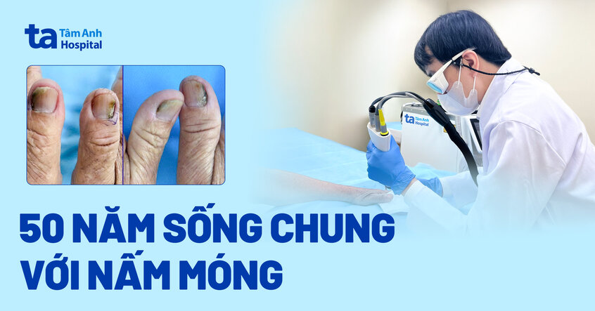 50 năm sống chung với nấm móng