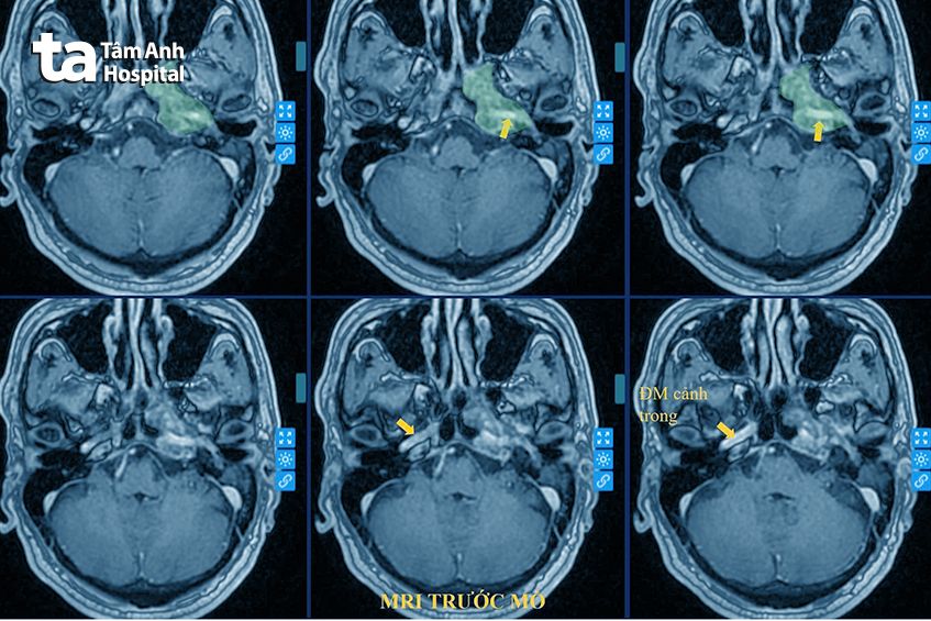 Ảnh chụp MRI khối u nằm sâu trong vùng xương đá.