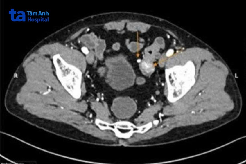 ảnh CT phát hiện khối u