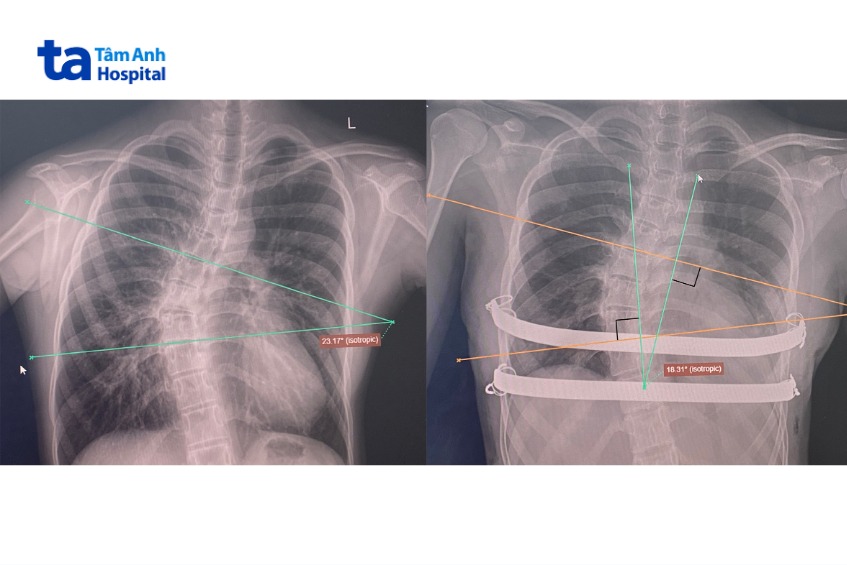 Ảnh X-quang trước mổ (trái) cho thấy vẹo cột sống ngực
