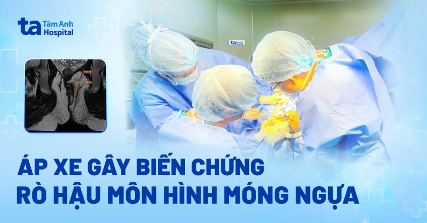 áp xe gây biến chứng rò hậu môn hình móng ngựa