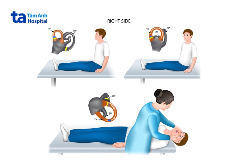 bài kiểm tra dix–hallpike