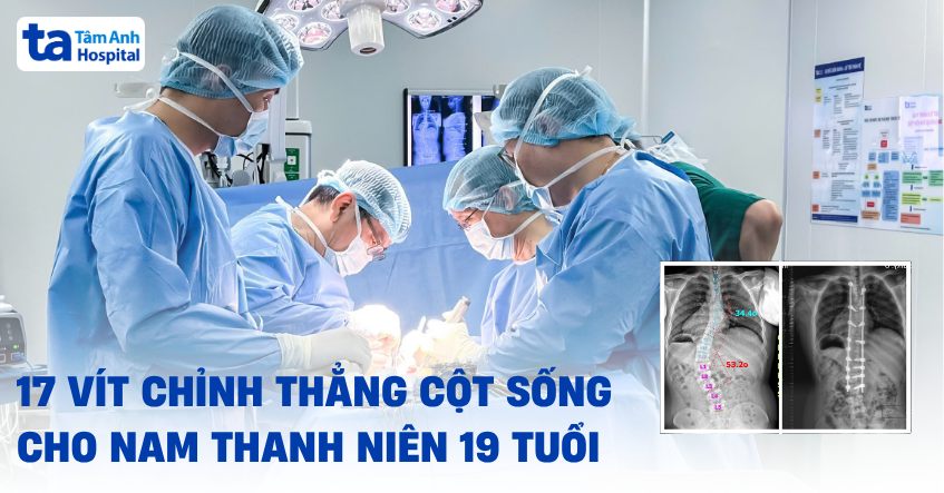 bắt vít chỉnh thẳng cột sống cho thanh niên