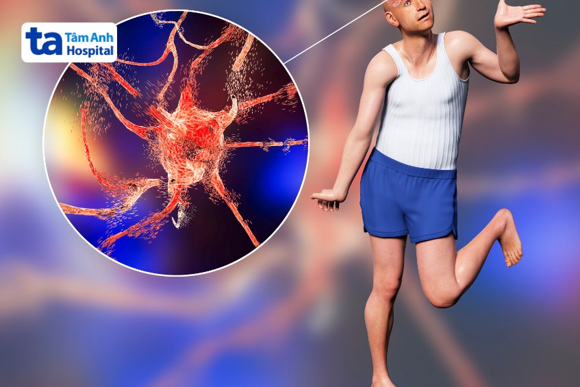 bệnh huntington gây múa giật