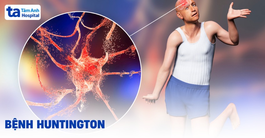 Bệnh Huntington: Nguyên nhân, biểu hiện, chẩn đoán, điều trị