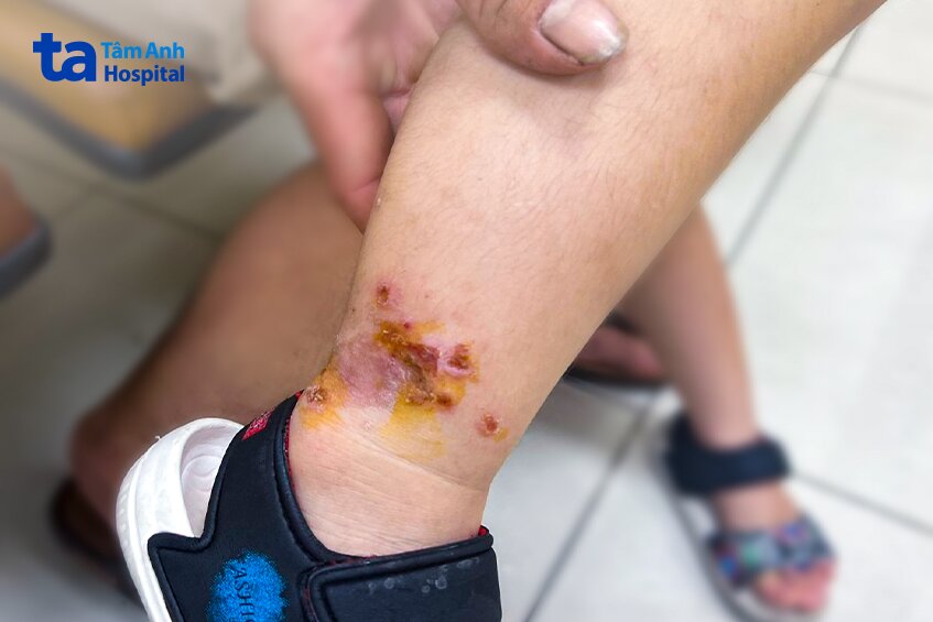 các bóng nước trên da của bé minh