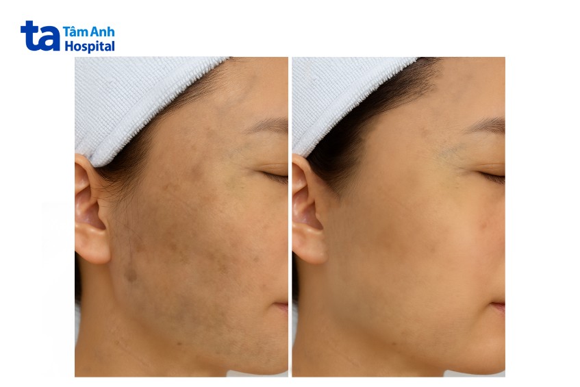 các đốm nâu và sạm nám của chị mỹ đã mờ dần sau gần 1 năm