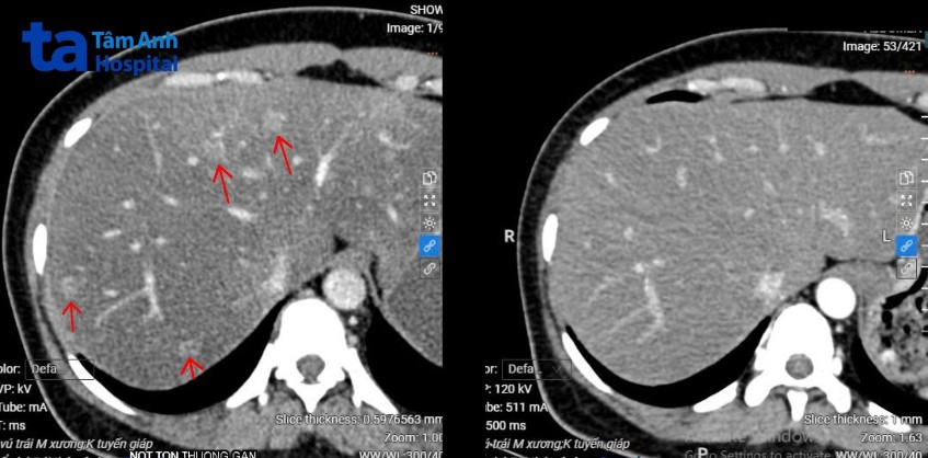 các khối u gan đa ổ của chị phương trước và sau điều trị