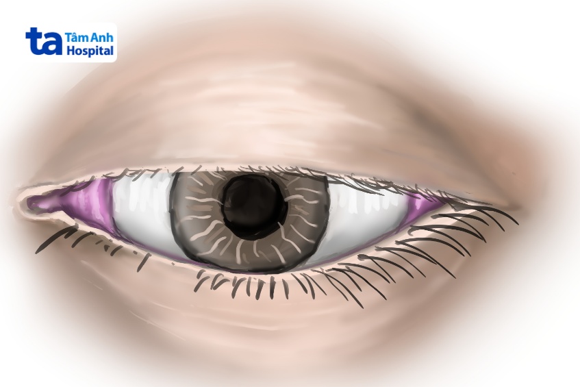 các vấn đề về mắt do viêm dây thần kinh sọ số 3