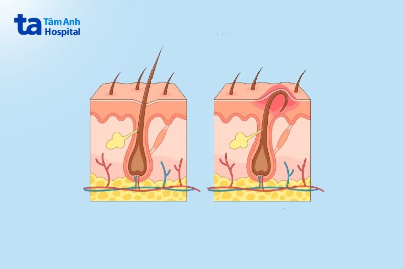 cạo lông chân sai cách làm lông mọc ngược viêm nhiễm