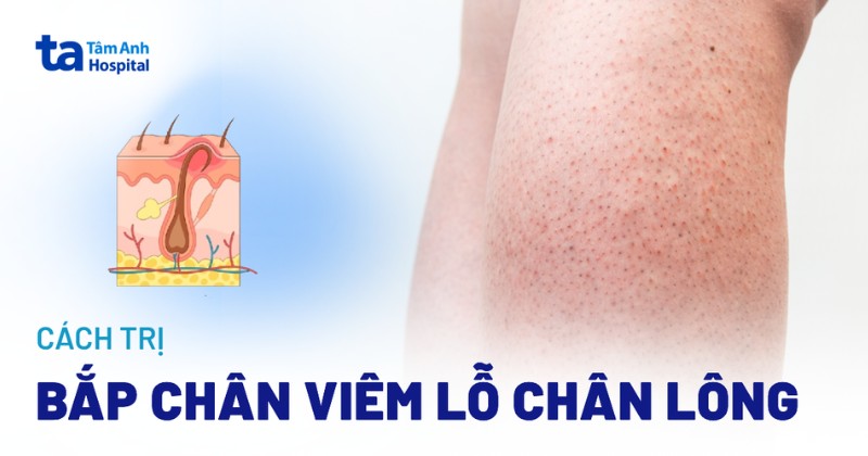 Cách trị viêm lỗ chân lông ở bắp chân đơn giản và hiệu quả