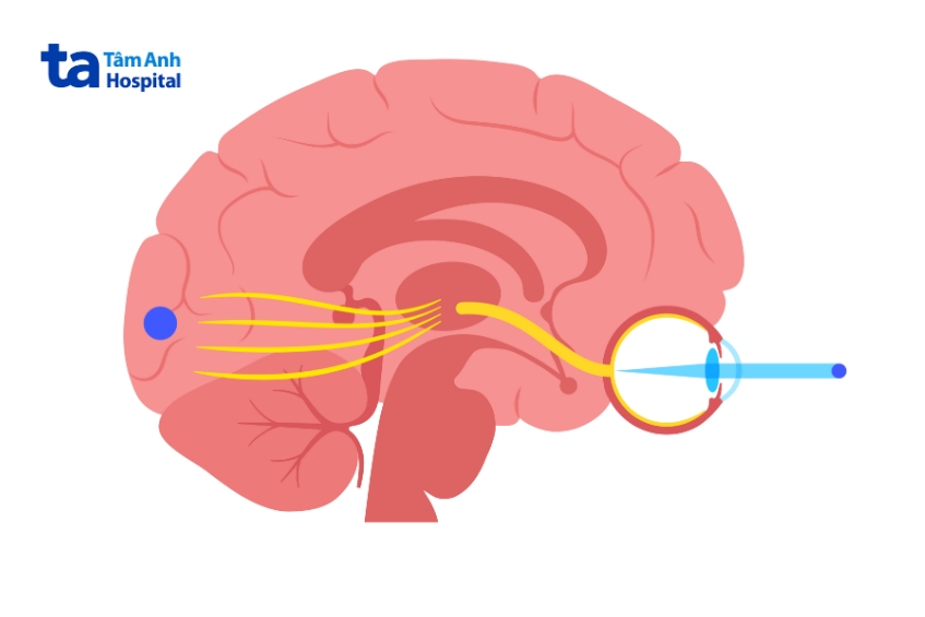 cần điều trị tình trạng viêm dây thần kinh thị giác sớm