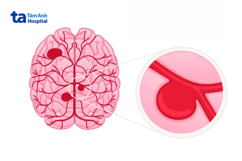 cảnh báo phình động mạch não