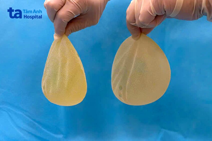 cặp túi ngực 40 tuổi được lấy ra