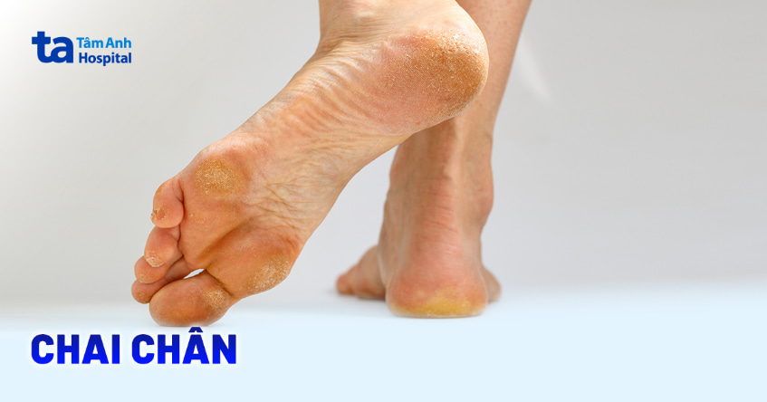 Chai chân do đâu? Hướng dẫn cách trị chai chân tại nhà
