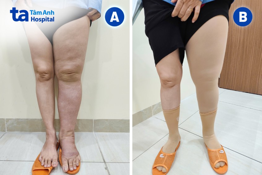 Chân trái bệnh nhân phù to và sau khi đặt băng ép hai tuần