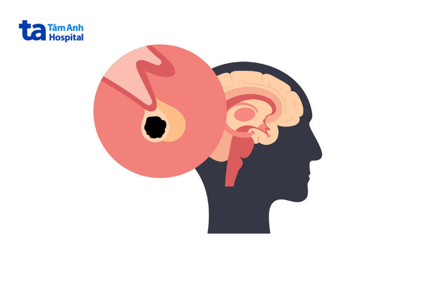 chỉ định mổ khối u chèn ép gây ra các triệu chứng bất lợi