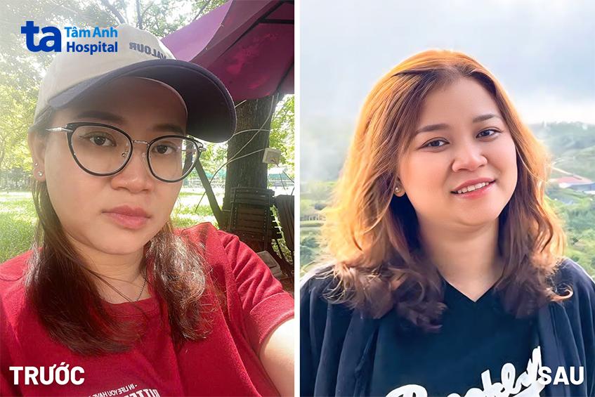 chị lan anh trước và sau khi mổ cận
