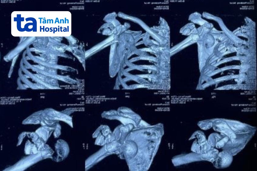 chụp ct khớp vai phải gãy nát của bệnh nhân