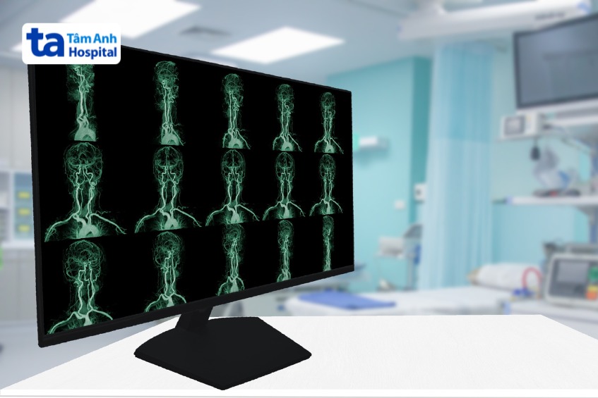 chụp ct mạch máu kiểm tra bệnh lý dây thần kinh