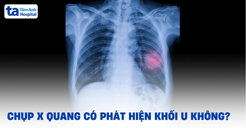 Chụp X quang có phát hiện khối u không? Ưu và nhược điểm