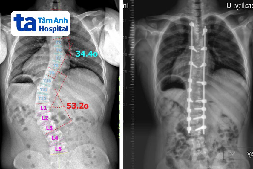 chụp x quang cột sống của linh