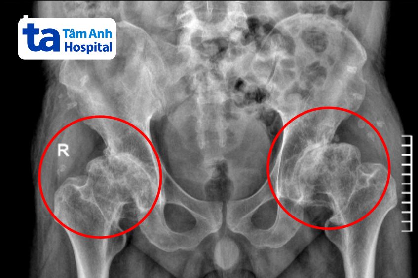 chụp x quang khớp háng người bệnh biến dạng