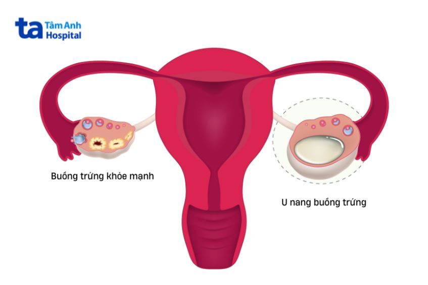 U nang có thể ở một hoặc hai buồng trứng